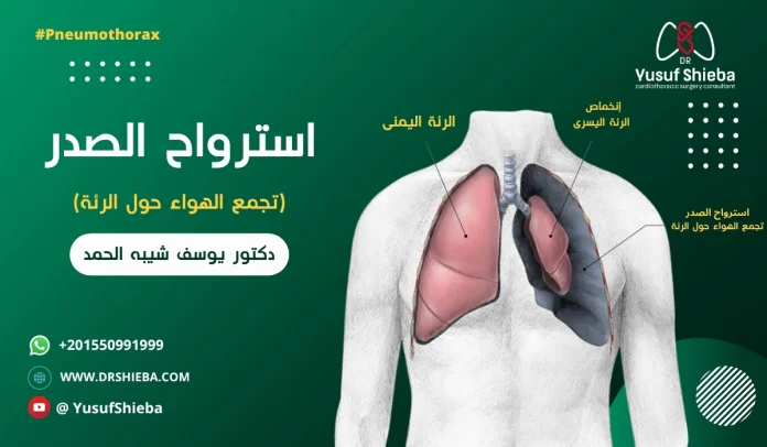 استرواح الصدر
